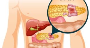 سرطان پانکراس چیست