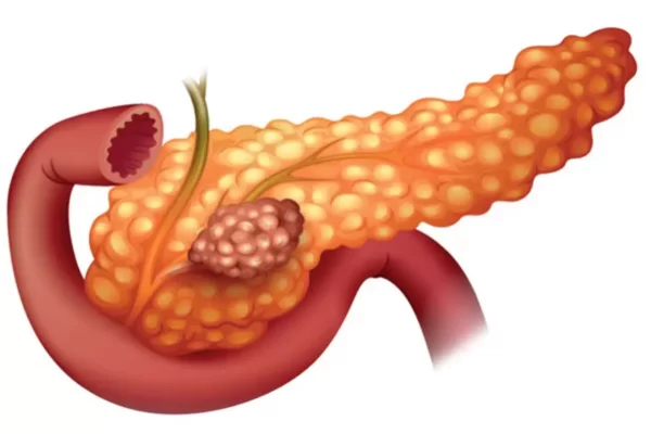 سرطان پانکراس چیست