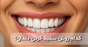 سفید کردن دندان‌ها: از بلیچینگ تا لمینت سرامیکی و کامپوزیت ونیر