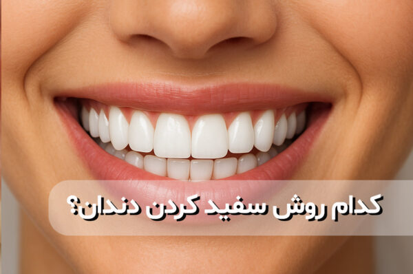 سفید کردن دندان‌ها: از بلیچینگ تا لمینت سرامیکی و کامپوزیت ونیر